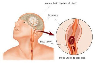 ตอนที่ 6 โรคหลอดเลือดสมอง” (STROKE) หรือ CEREBRO VASCULAR ACCIDENT (CVA)